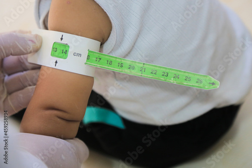 Measuring malnutrition using strap MUAC mid-upper-arm-circumference. A doctor examines child malnutrition