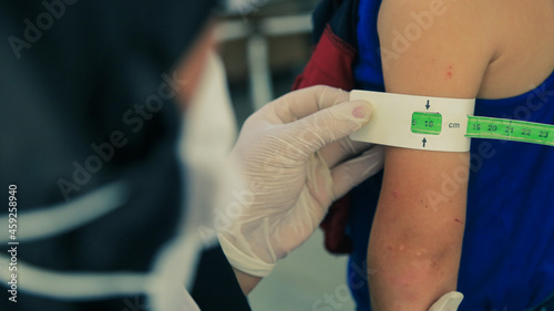 Measuring malnutrition using strap MUAC mid-upper-arm-circumference. A doctor examines child malnutrition