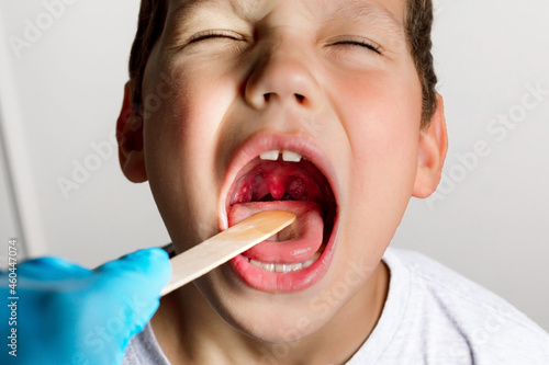 The boy's mouth is wide open with tonsils are enlarged, visible in the white or yellowish tinge on a gray background. Pediatrician checking 8-aged schoolboy's throat applying wooden spatula.