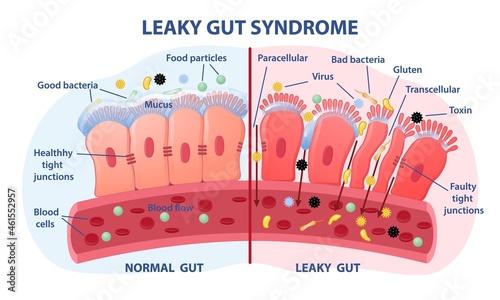 Leaky gut Syndrome concept. Comparison of healthy organ and inflamed tissue cells. Diseases of gastrointestinal tract. Toxins and viruses. Cartoon flat vector illustration isolated on white background