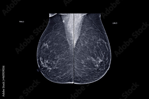  X-ray Digital Mammogram or mammography both side of the breast MLO view for diagnonsis Breast cancer in women isolated on black background.
