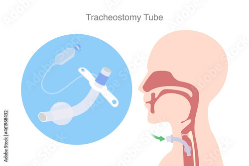 Tracheostomy tube is a device to help a patient who can not breathe with nose and mouth. Illustration about Tracheostomy is surgical to inserted a siliconized tube into the trachea to help breath.