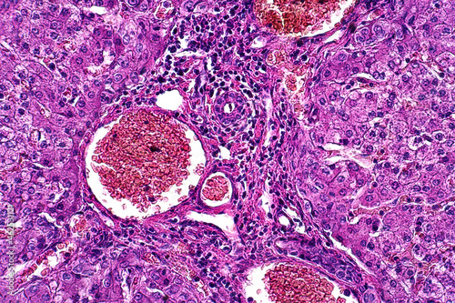 Light microscope of Parenchymatous and fatty degeneration of liver pathology.