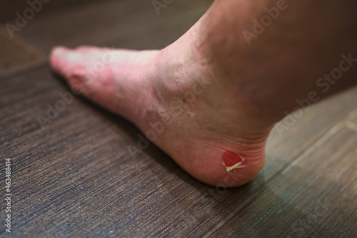 A punctured blister on the heel of a man's foot caused by forceful rubbing.