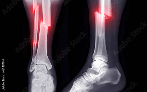 X-ray image of ankle joint showing fracture tibia and fibula bone.'