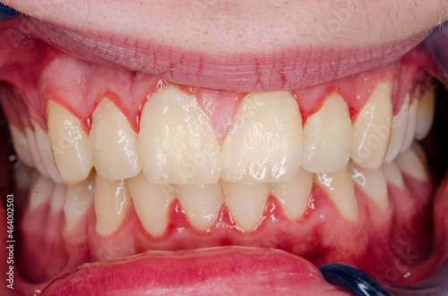 gingivitis and dental plaque, upper incisors