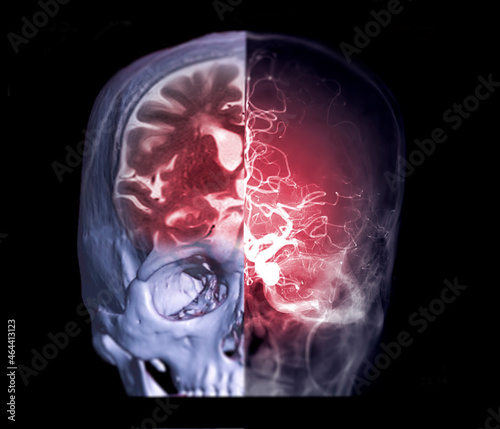 Fusion image of CT MRI brain and Cerebral angiography image front view showing anatomical of the brain and cerebral artery.