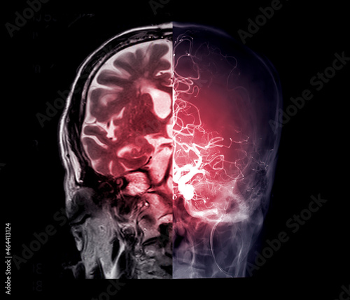 Compare MRI brain coronal view Cerebral angiography image front view showing position of cerebral artery.