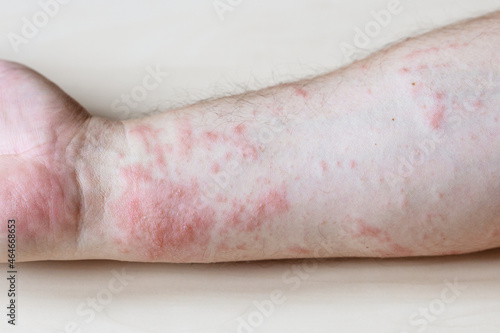 sample of Allergic contact dermatitis - itchy rash on side of forearm close up