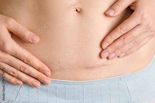 Close-up of a woman's abdomen after a cesarean section a year later. Healing scar after surgery