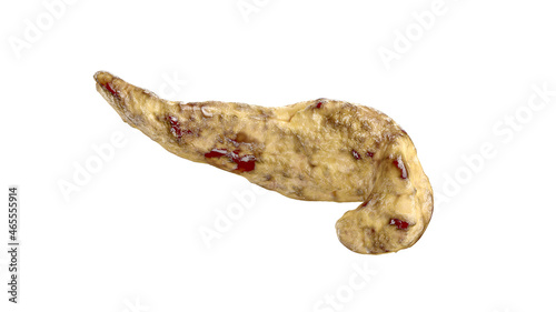 Pancreatitis disease of human pancreas isolated on white. Acute hemorrhagic pancreatitis with fatty necrosis of pancreas. 3d illustration 