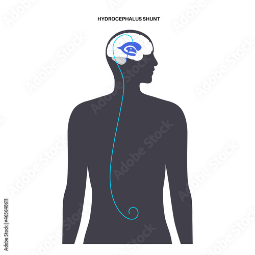 hydrocephalus shunt concept