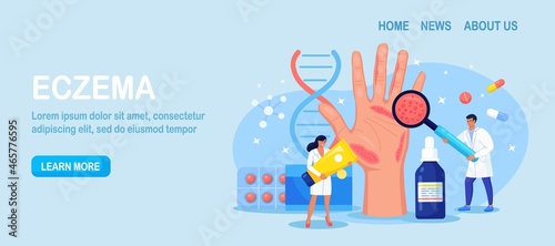 Dermatologist Exam Big Hand with Red Skin and Ras. Psoriasis, Vitiligo, Dermatitis. Eczema - Inflammation Skin Disease. Consequences of Improper Care, Frequent Hand Washing Disinfection. Vector design