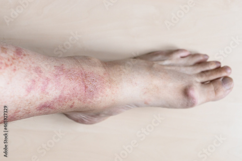 sample of Allergic contact dermatitis - male shin with redness and itchy rash on skin
