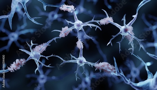 Amyloid plaques in Alzheimer's disease