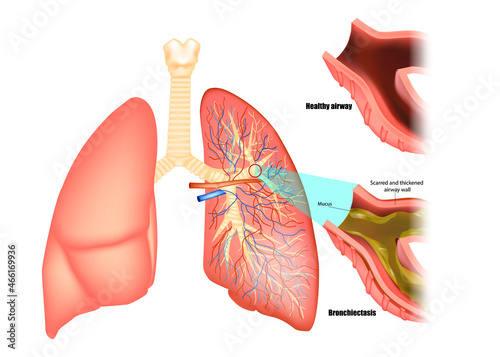 Illustration of lungs affected by bronchiectasis disease. Obstructive lung disease
