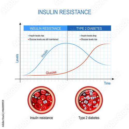 Insulin resistance and Type 2 diabetes