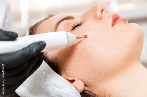 Professional salon procedures. Surgeon using a laser device for removing mole. Removal of birthmark from female face. Close up. Concept of laser cosmelotogy and electrocoagulation
