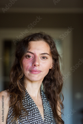 portrait of beautiful girl woman with birthmark on her face. Concept about body positivity and self acceptance