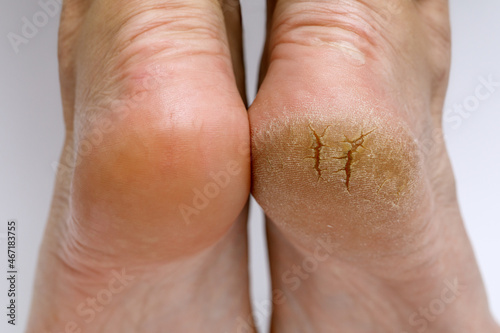 Cracked heels before and after treatment and treatment. Medical pedicure in a beauty salon. Problematic dehydrated feet with dry skin.