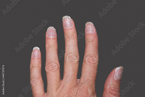 Close- up of bitten and brittle nails without manicure. Overgrown cuticle fingernails and tainted nail plate. Cuticle overgrown nails and damaged nail plate. Concept of nail care and health.