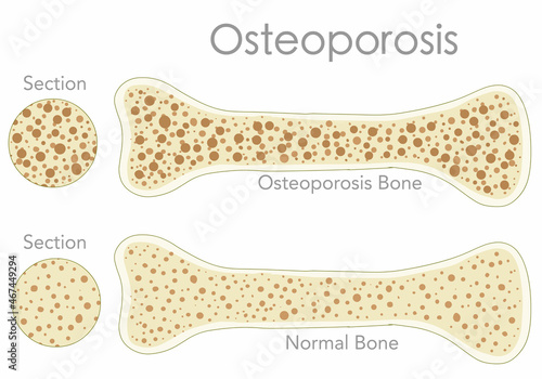 Porous bone, Osteoporosis. Bone cross section, structure. Pair, normal, health, mass and pore, fragile, spongy, osteoporotic bone, anatomy diagram. White back, textures. Medical illustration vector