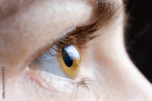 Macro photo of the human eye with corneal disease keratoconus