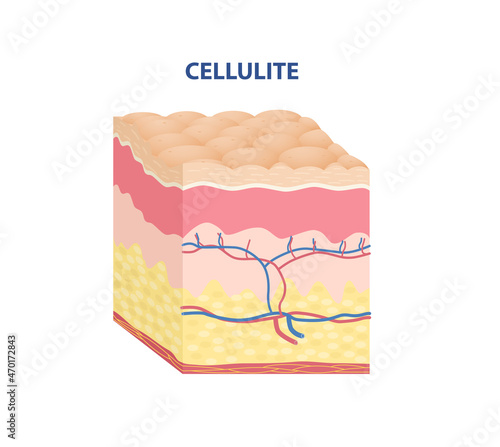 Skin Type Sticker. Uneven epidermis with cellulite. Rough subcutaneous layer. Design element for scientific websites and apps. Cartoon isometric vector illustration isolated on white background