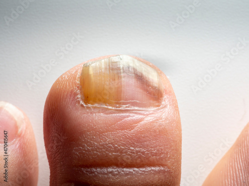 Nail infections caused by fungi such as: onychomycosis also known as tinea unguium. Caused by dermatophytes and yeasts and for the concomitant antibacterial activity