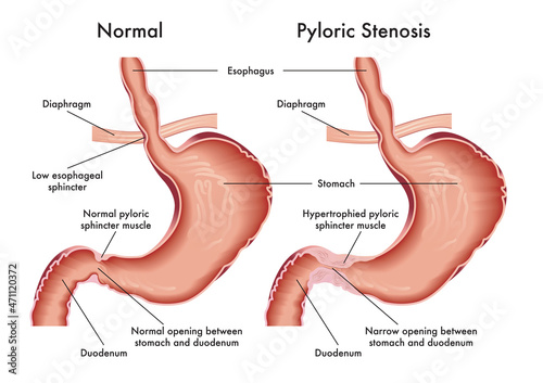 Medical illustration of symptoms of pyloric stenosis