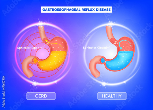 Human stomach. Heartburn and Gastroesophageal Reflux Disease (GERD). The stomach releases strong acids to help break down the food. Medical and healthy food nutrition concept. 3D vector.