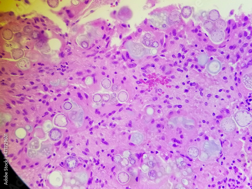 Coccidioides imitis spherules on H and E pathology specimen