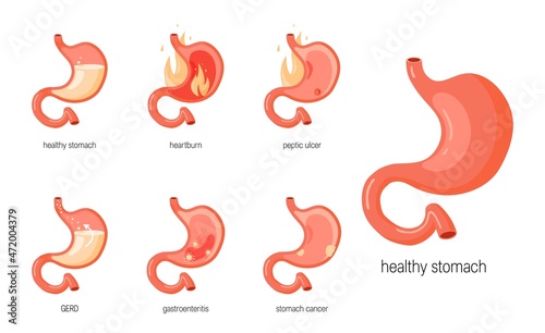 Stomach diseases concept in flat style, vector