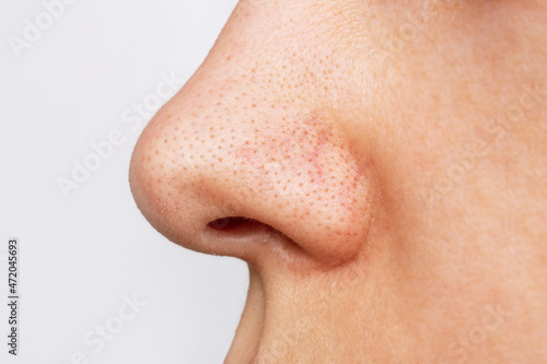 Close-up of a woman's nose with blackheads or black dots isolated on a white background. Acne problem, comedones. Enlarged pores on the face. Profile. Cosmetology dermatology concept