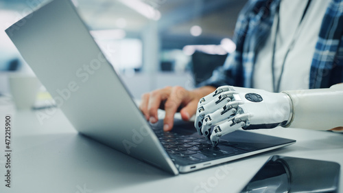 Close-up on Hands: Programmer With Disability Using Prosthetic Arm to Work on Laptop Computer. Specialist Swift and Natural Use of Myoelectric Bionic Hand To Type Code for Software