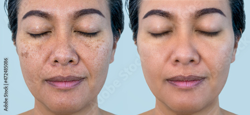 Retouched image to show before and after treatment spot melasma pigmentation facial treatment on young asian woman face. Skincare and health problem concept. 