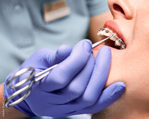 Close up of dentist hand putting elastic rubber band on patient brackets. Woman with wired metal braces on teeth receiving orthodontic treatment. Concept of stomatology, dentistry and orthodontics.