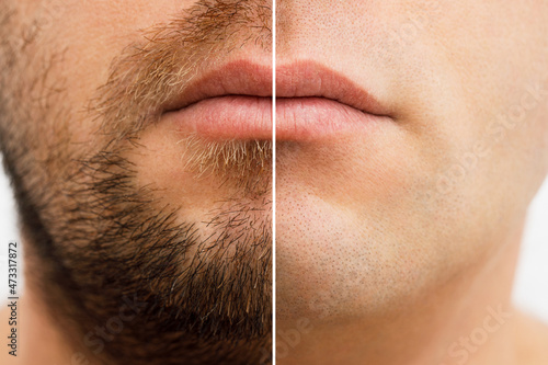 Close up photo of a man's face before and after shaving. a young man with a beard. Comparison of a man's face with a beard and without a beard. use of aftershave cream.