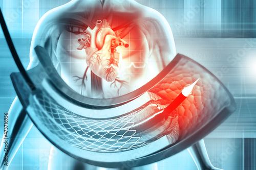 Stent and catheter for implantation into blood vessels