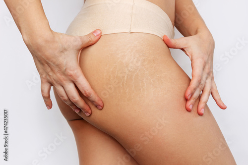 Close-up of a female thigh with white stretch marks from a sharp weight loss or weight gain isolated on a white background. Changes in the body. Cosmetology, beauty