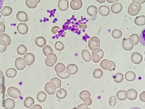 Essential thrombocytosis blood smear showing abnormal high volume of platelet and low count of White Blood Cell analyze by microscope. Leucopenia and thrombocythemia. Microscopic zooming image.