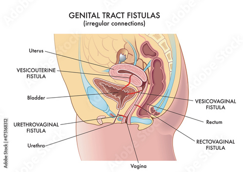 Medical illustration of the irregular connections called fistulas that can be found in the woman's genital tract.