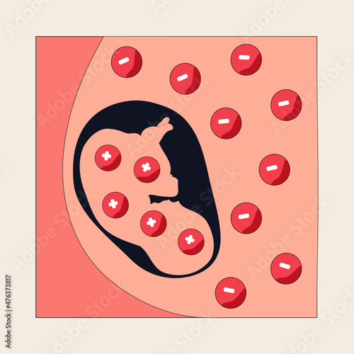 Hemolytic disease of the fetus and newborn Infographic. Vector illustration of Rh disease, isoimmunization, Rh D