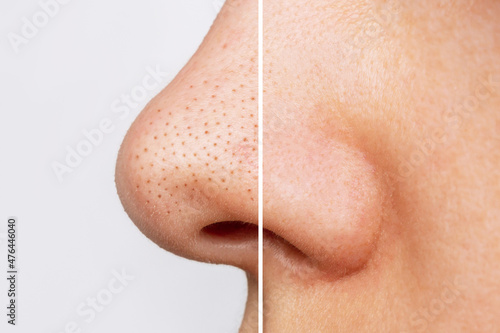 Close-up of woman's nose with blackheads or black dots before and after peeling, cleansing the face isolated on a white background. Acne problem, comedones. Profile. Cosmetology dermatology concept
