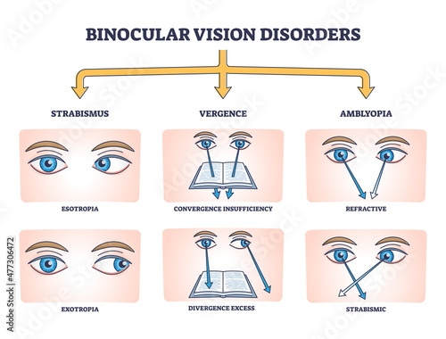 Binocular vision disorders with all eye defect examples outline diagram. Labeled educational anatomical strabismus, vergence and amblyopia division vector illustration. Medical sight health problems.