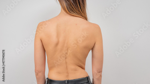 Woman with scoliosis of the spine. Curved woman's back with acne skin.