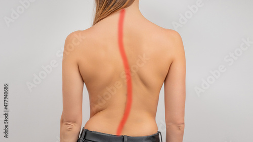 Woman with scoliosis of the spine. Curved woman's back.