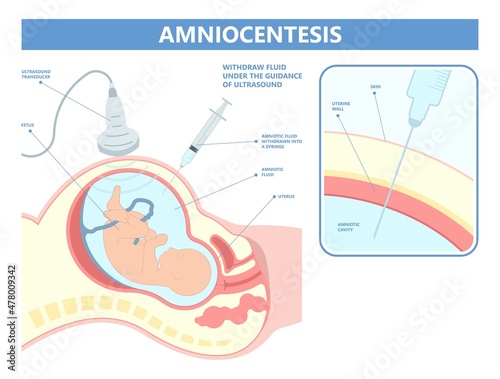 Amniocentesis diagnostic test treat LAB analysis DNA gene screen risk detect neural tube exam villus CVS check baby cell birth fetal sex down afp tay sachs spina alpha fetus loss cystic second fluid