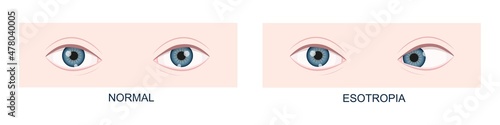 Esotropia. Horizontal strabismus before and after surgery. Eye misalignment, cross-eyed condition. Human eyes healthy and with inward gaze position. Double vision. Vector cartoon illustration
