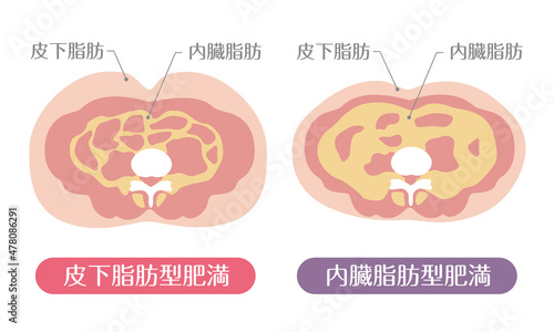 肥満のタイプ 皮下脂肪と内臓脂肪 